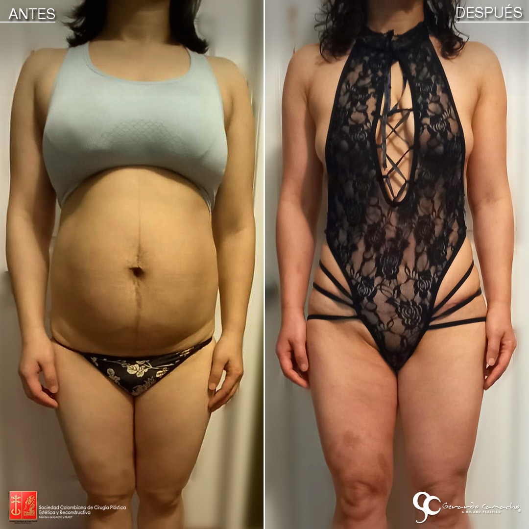 Abdomen plano logrado con abdominoplastia en Bogotá